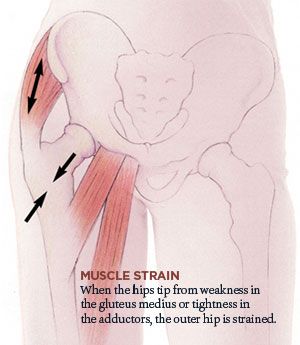 Muscle Strain and Hip Joint Pain